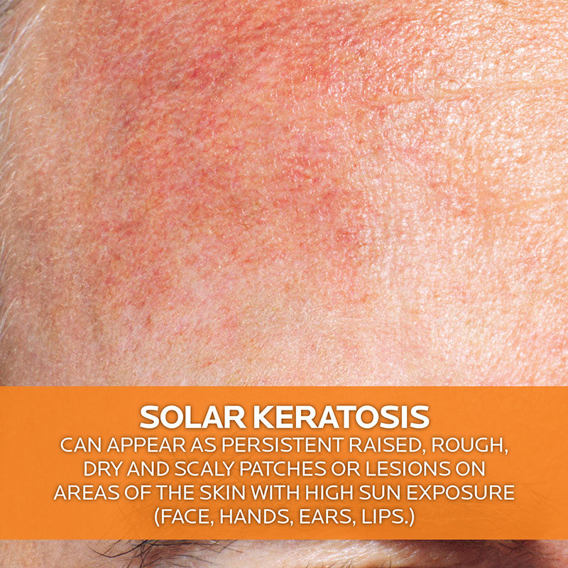 La Roche-Posay Anthelios KA+ Sunscreen SPF 50+ 50ml